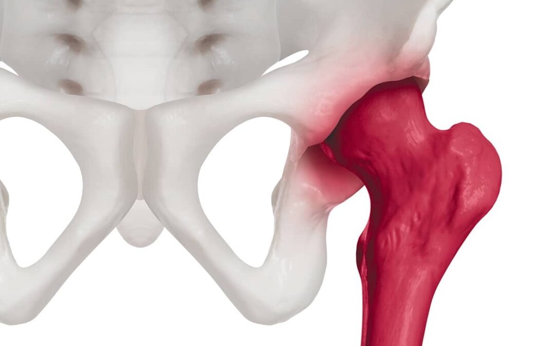 Definición de artrosis de cadera